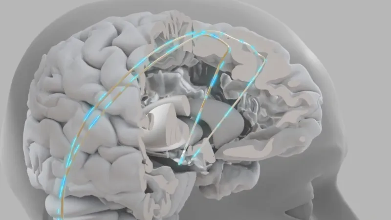 Brain Implants Closer: IIT Expert Urges Europe to Expedite Human Trials