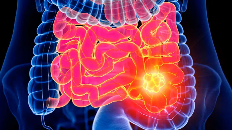 Nations Prove Zero Avoidable Colorectal Cancer Deaths Possible