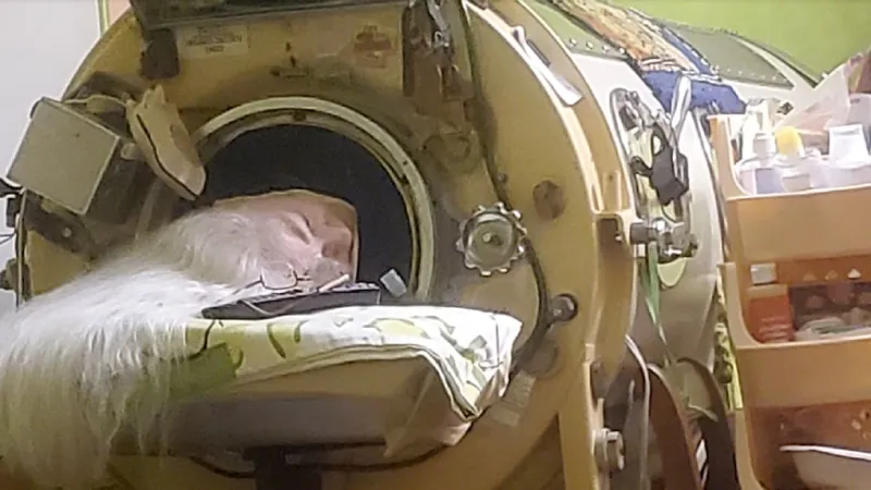 Iron Lung Era Closes: Last Known Patient Dies After 70 Years