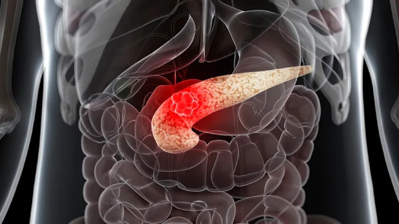 Pancreatic Cancer: New Treatments Offer Hope Against Aggressive Disease